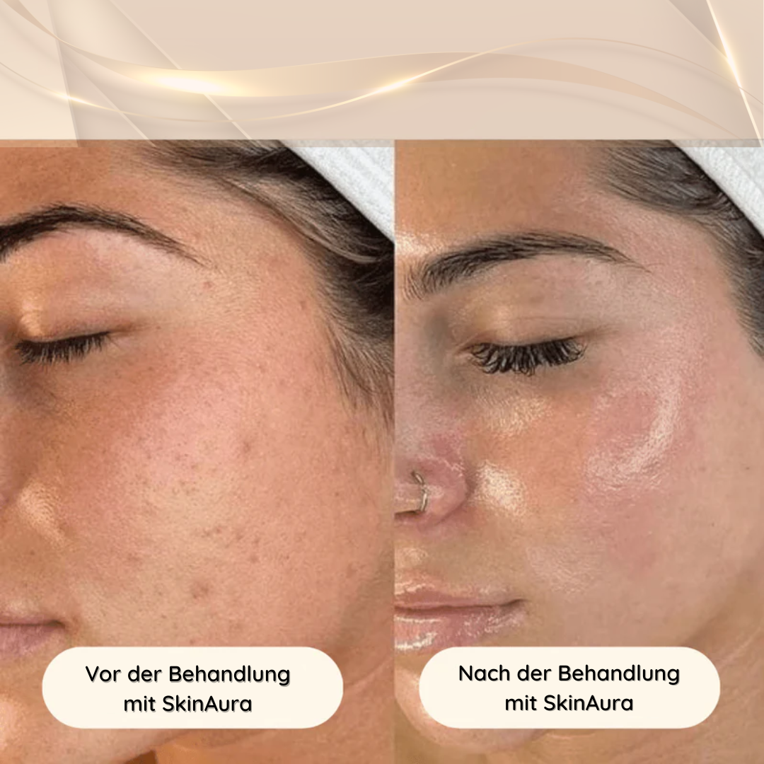 SkinAura | Hochfrequenzstab Gesicht & Body 6-in-1 Testsieger Set
